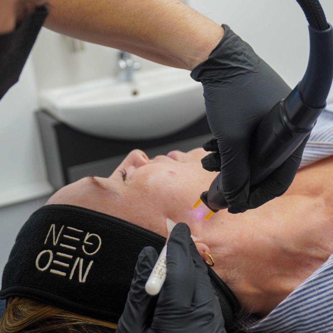 NeoGen™ Plasma Skin Rejuvenation at DermaMedica