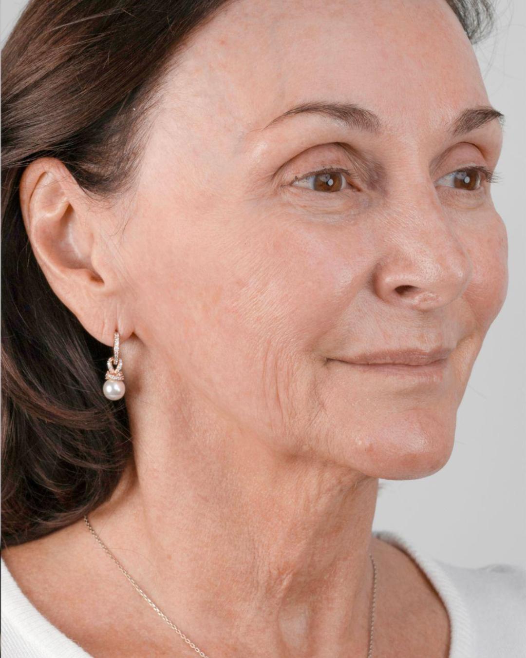 Shirley Ballas — NeoGen™ non-surgical facelift results