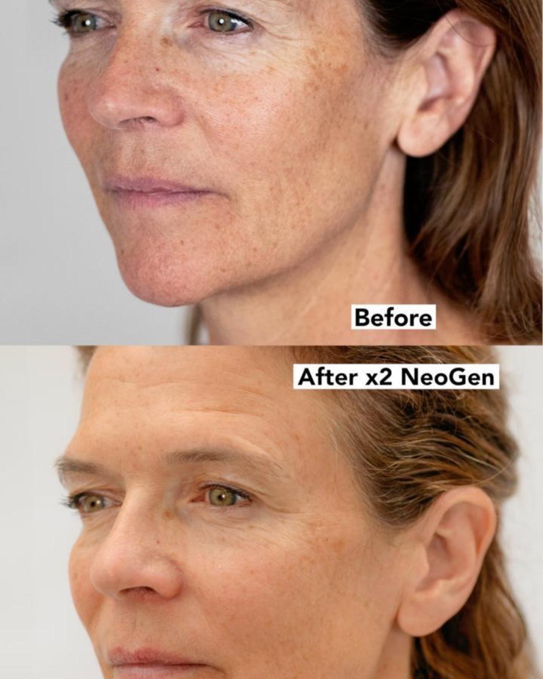 Annabel Croft — NeoGen™ plasma before and after skin rejuvenation results