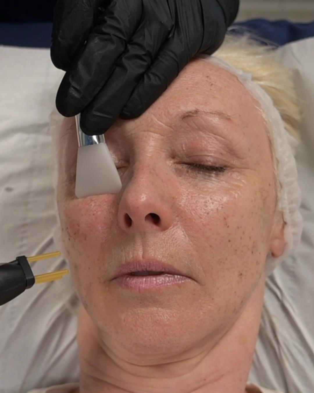 Debbie McGee — NeoGen™ plasma skin treatment results